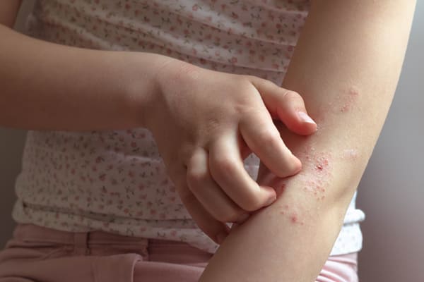 Dermatite e Omeopatia - Omeopatia per la cura della dermatite